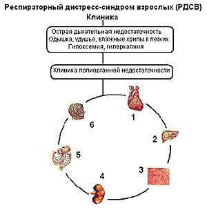 Острый респираторный дистресс-синдром, или ордс.