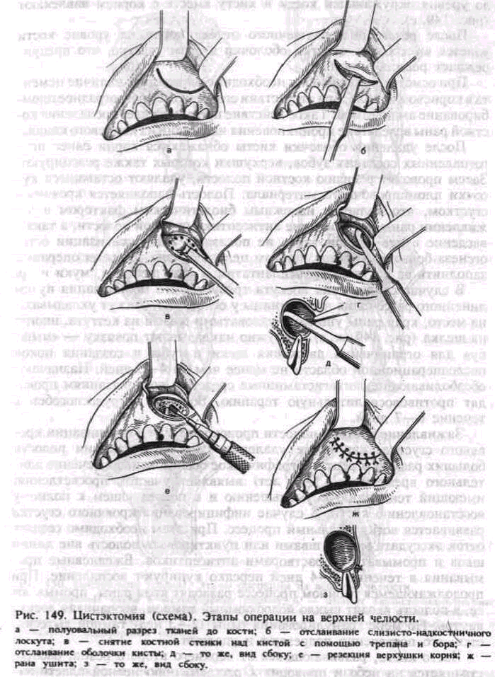 Цистоэктомия. Этапы операции резекции верхушки корня зуба.. Операция цистэктомия (с резекцией верхушки корня и без нее). Цистэктомия с резекцией верхушки корня. Цистотомия кисты челюсти.