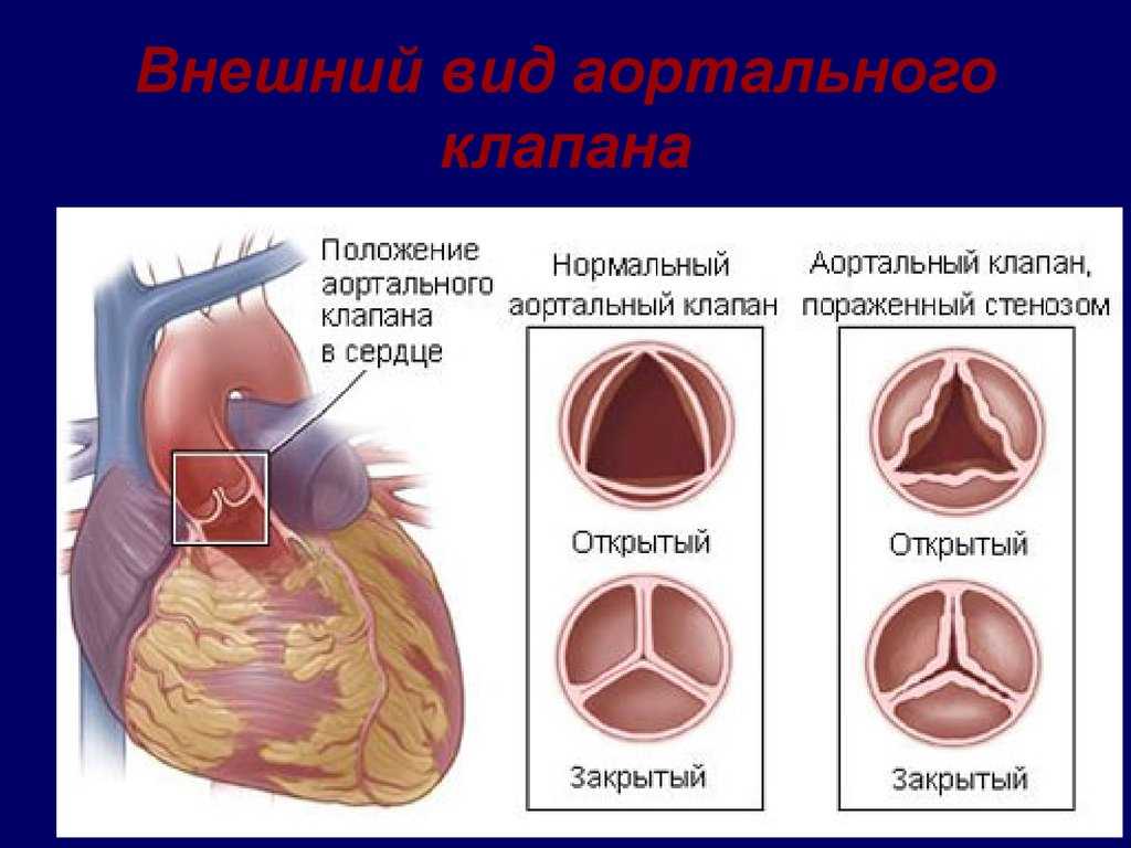 Аортальный клапан картинка