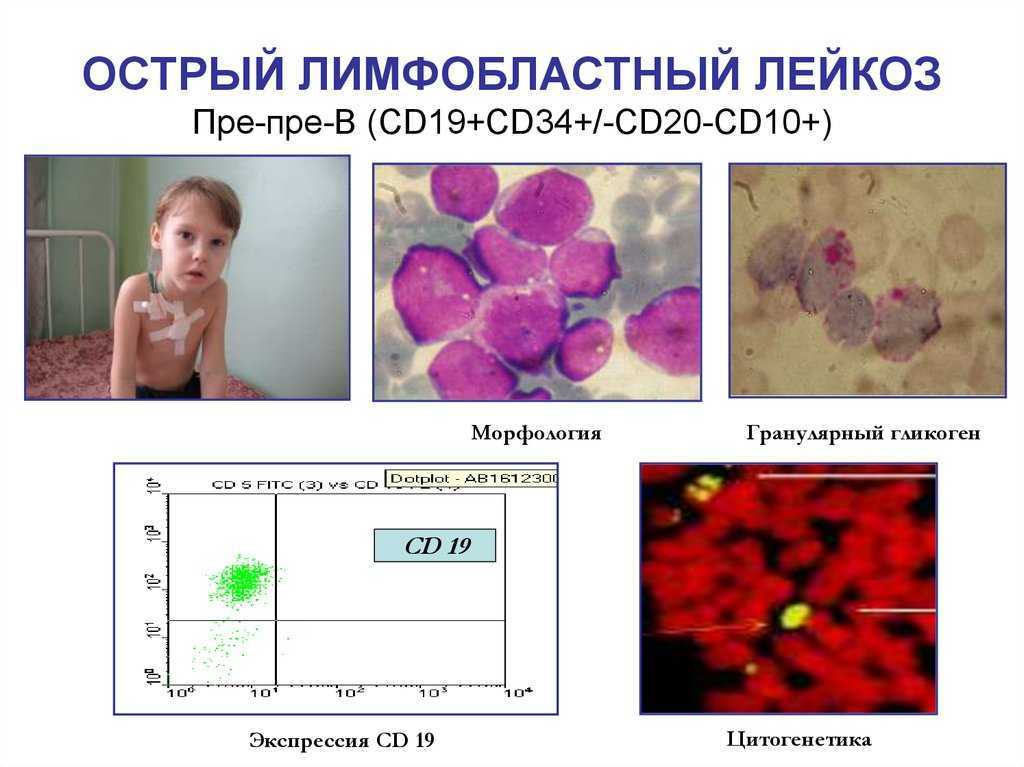 Лейкоз. лейкемия. рак крови
