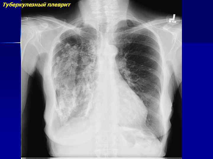 Туберкулезный плеврит презентация