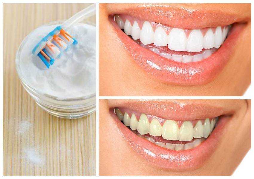 Отбеливание зубов содой в домашних условиях – противопоказания к процедуре