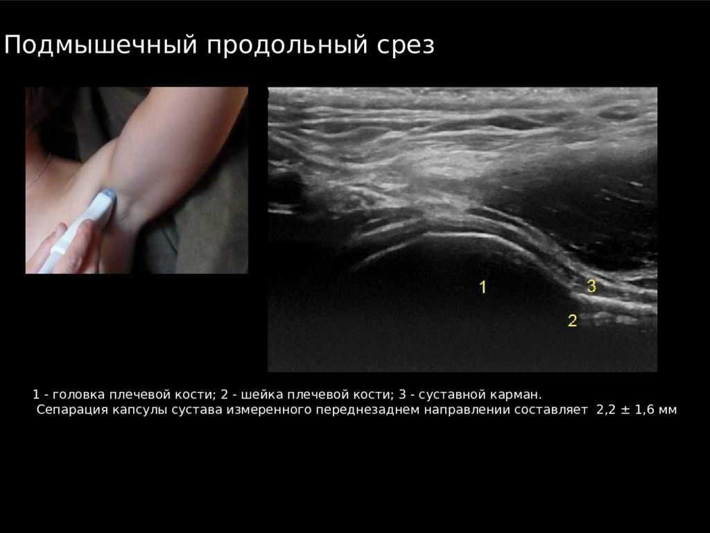 Перелом ключицы. причины, симптомы, виды, первая медицинская помощь и реабилитация :: polismed.com