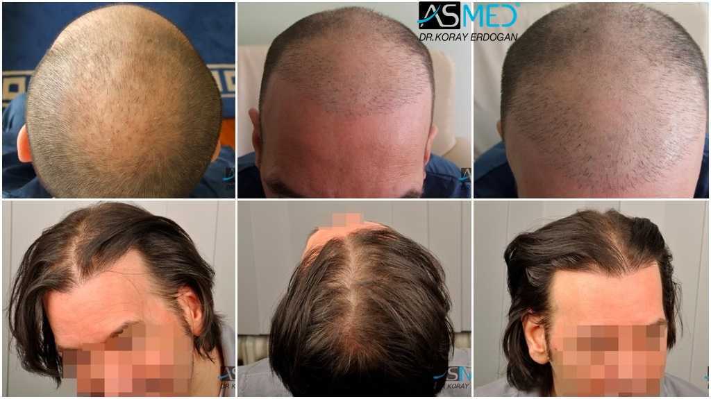 Месяц после пересадки волос. До и после пересадки волос. Результаты после пересадки волос.