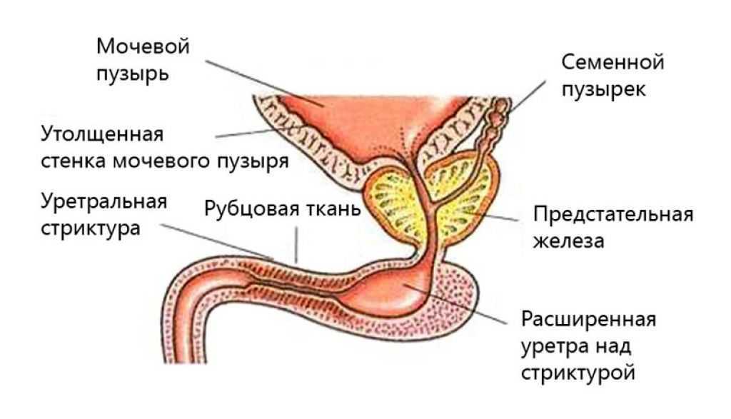 Стриктура уретры