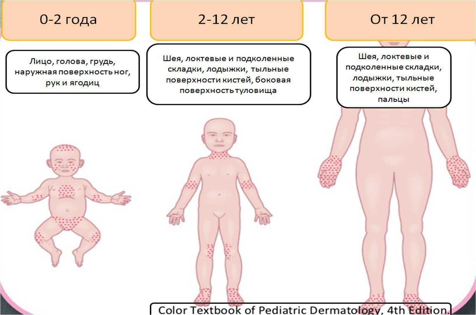 Атопический дерматит у ребенка 1 год