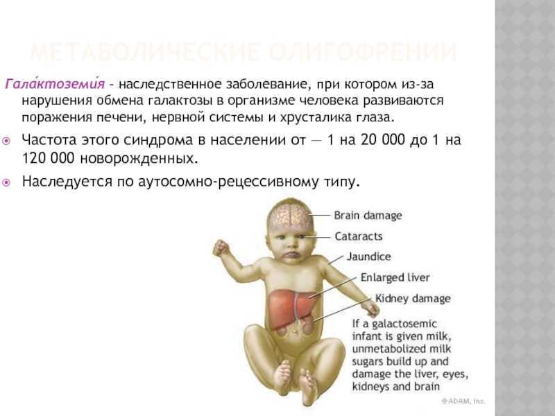 Галактоземия у детей презентация