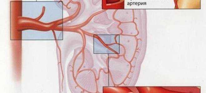 Тромбоз почечной вены. Коленообразная почечная артерия. Тромбоз почечной артерии. Атеросклероз почечных артерий Патан. Атеросклероз артерий почек почечная форма.