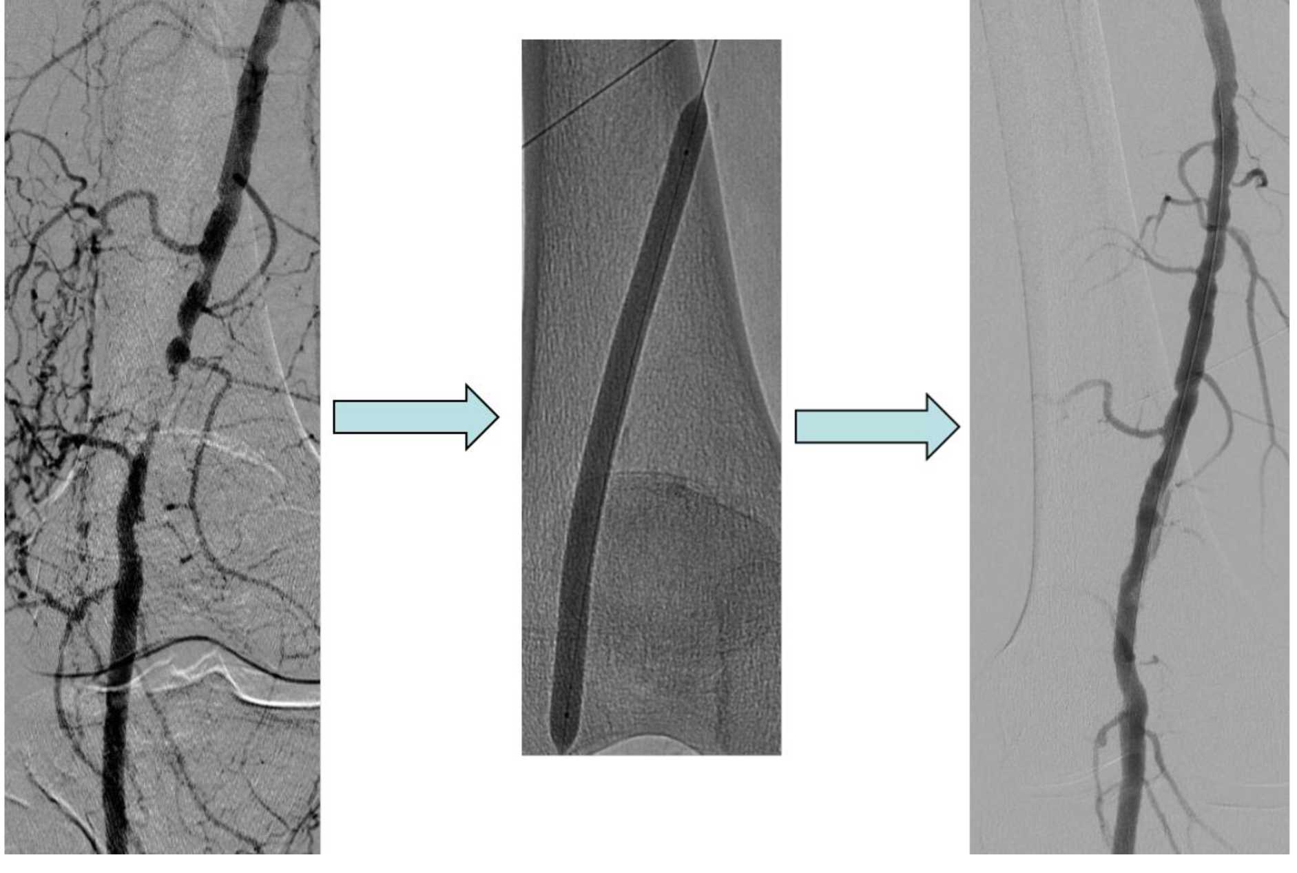 Бедренная артерия человека | анатомия бедренной артерии, строение, функции, картинки на eurolab