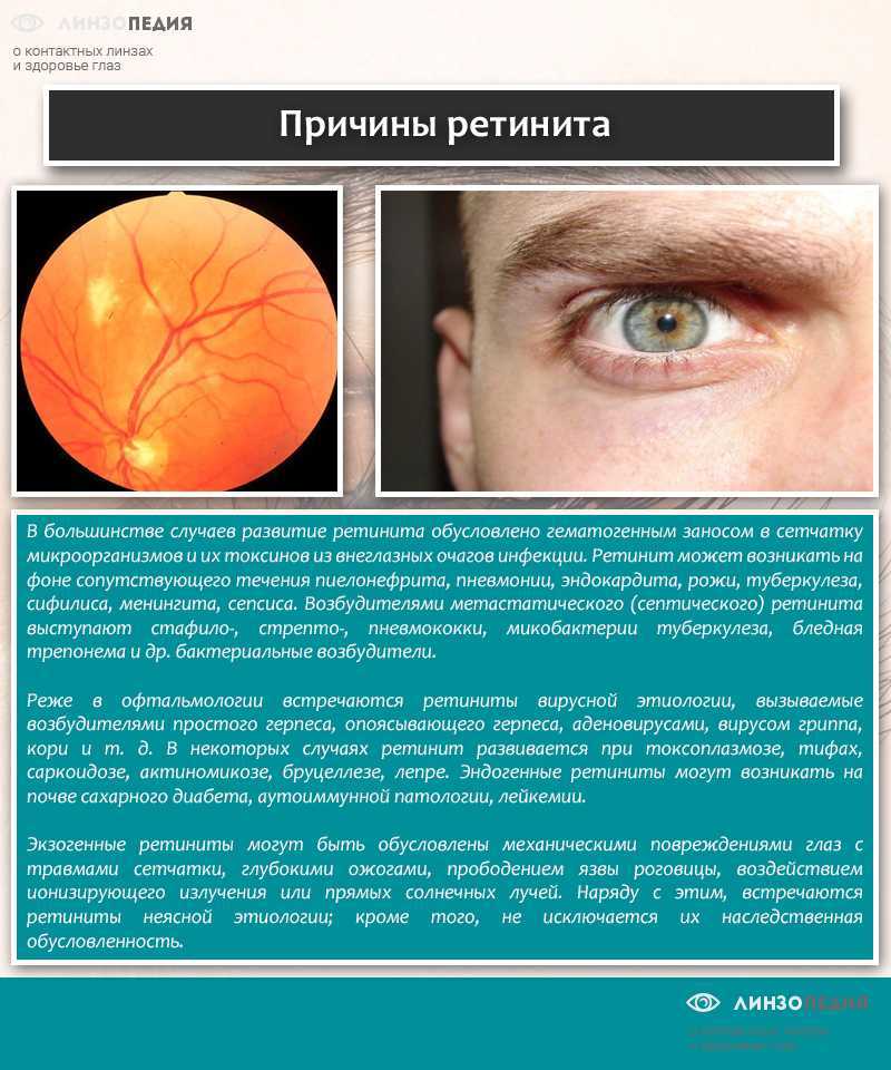 Воспаление сетчатки. Отслойка сетчатки симптомы. Пигментный ретинит сетчатки. Болезнь с глазами отслоение сетчатки.