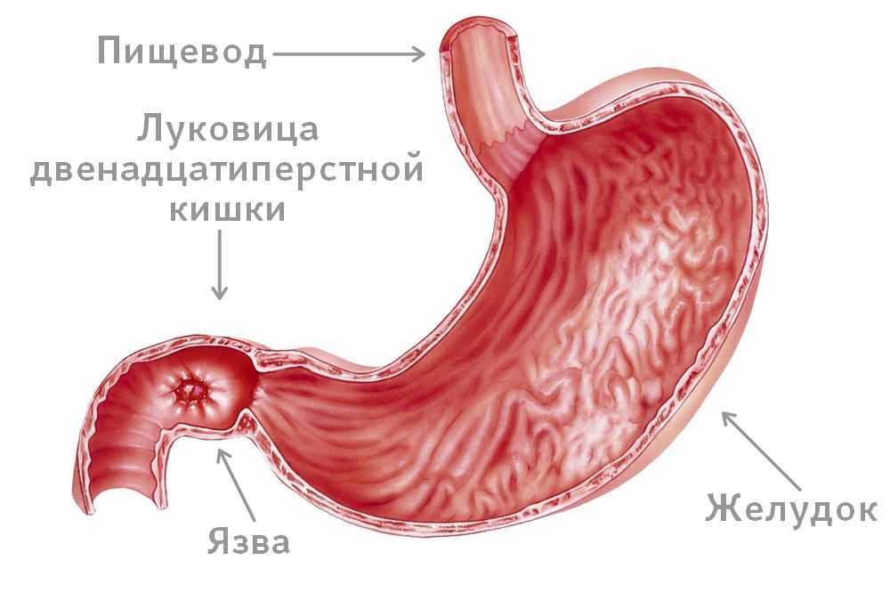 Хронический гастродуоденит: симптомы и лечение у взрослых и детей – эл клиника