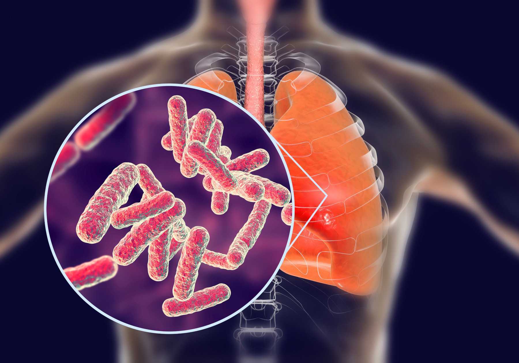 Туберкулез мочеполовой системы - симптомы, осложнения, диагностика | университетская клиника