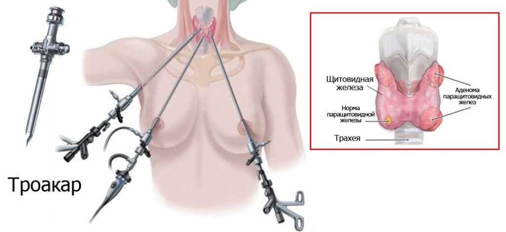 Сколько длится операция щитовидной