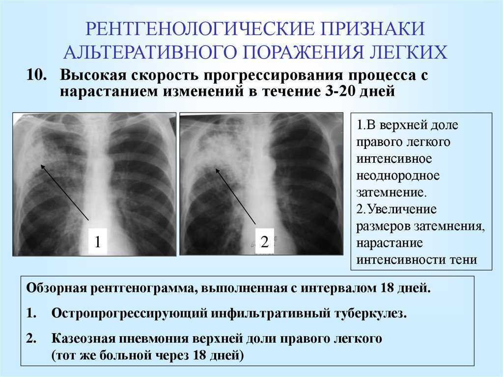 Рентген при туберкулезе - симптомы, признаки, описание рентгена при пневмонии :: polismed.com