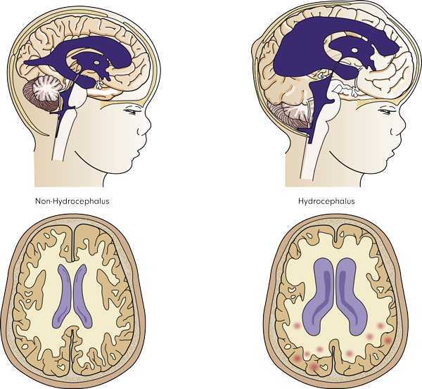 Гидроцефалия головного мозга картинки