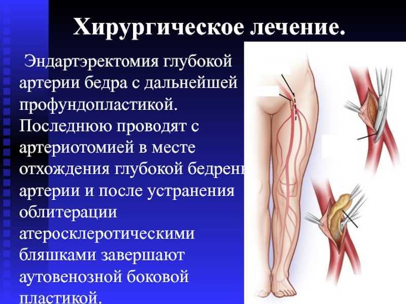 Что такое окклюзия бедренной артерии. методы лечения