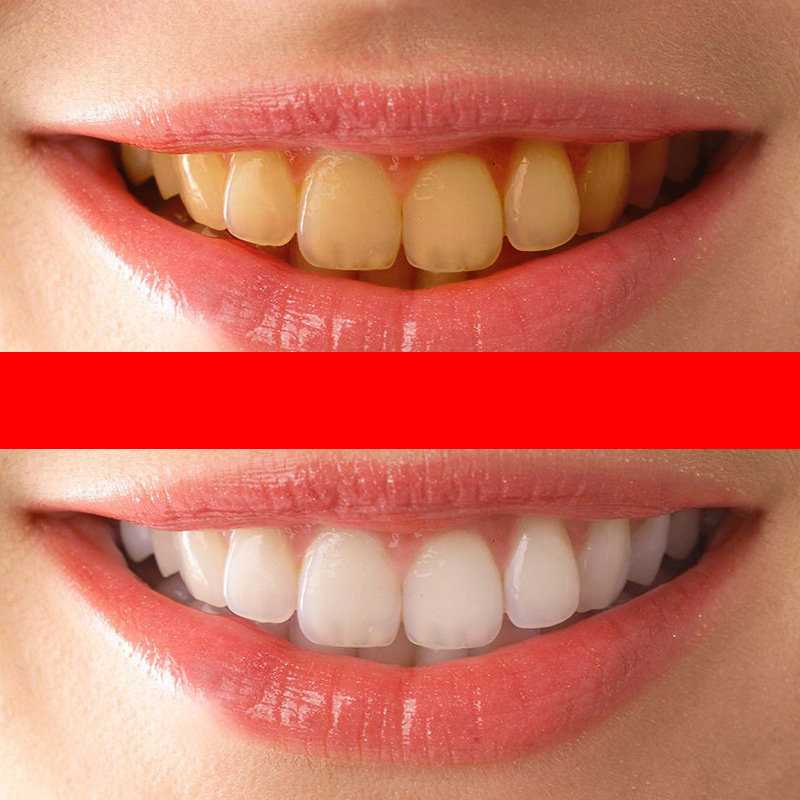 Белоснежная улыбка  —  в чем секрет? почему зубы меняют цвет и почему отбеливать зубы это вредно?