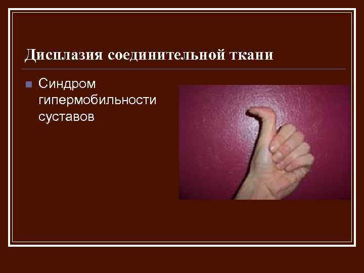 Чем опасна гипермобильность суставов - нолтрекс.