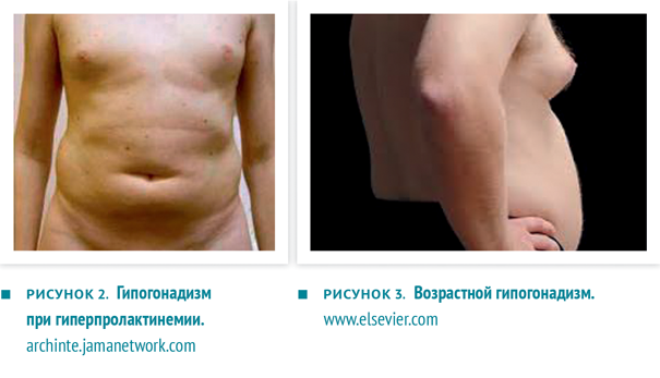 Повышенный тестостерон у женщин: симптомы, лечение, последствия, причины, как исправить | национальный центр репродукции «эко-содействие»