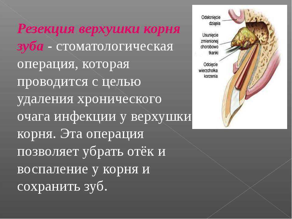 Резекция верхушки зуба