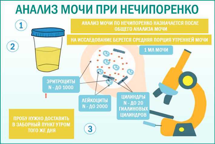 Микроскопия осадка мочи: норма и расшифровка результатов