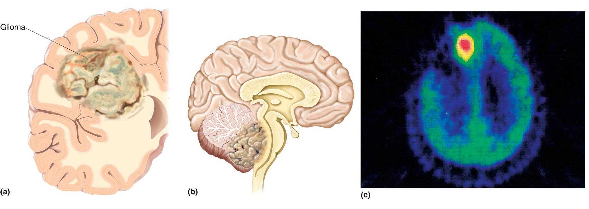 Глиома злокачественная опухоль головного мозга