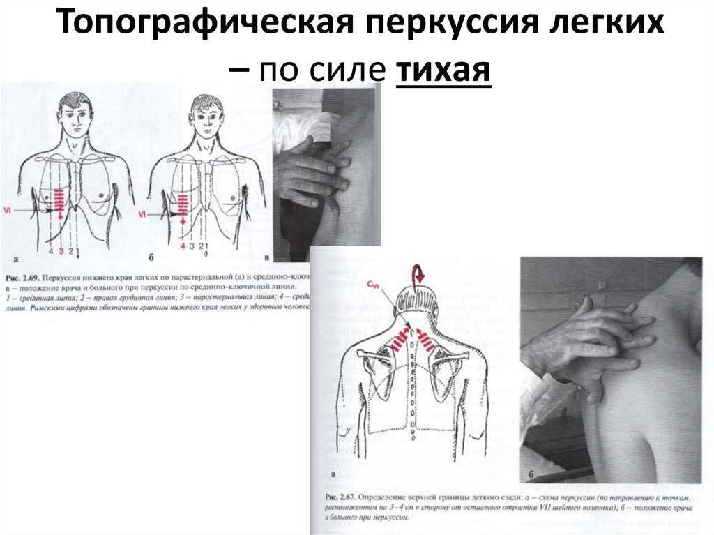 Схема сравнительной перкуссии легких