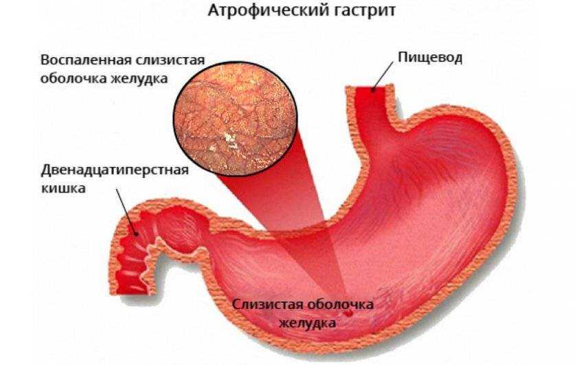 Язвенная болезнь желудка: причины заболевания, методы лечения и профилактики