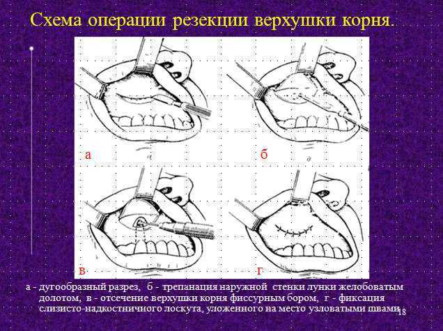 Схема резекции верхушки корня