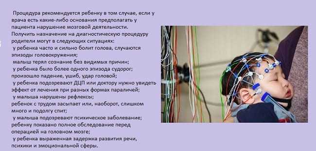 Что показывает ээг головного мозга у детей, расшифровка ээг-видеомониторинга дневного и ночного сна
