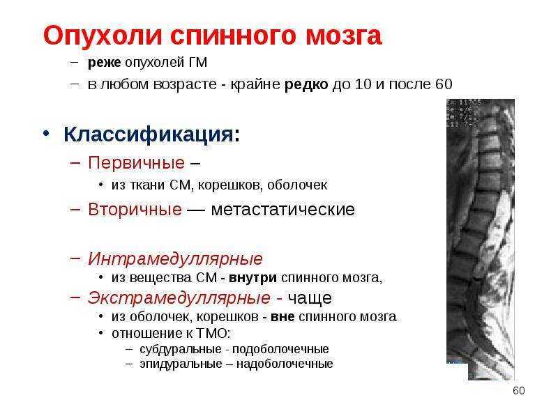 Спинной мозг - лечение воспалительных и др. заболеваний спинного мозга