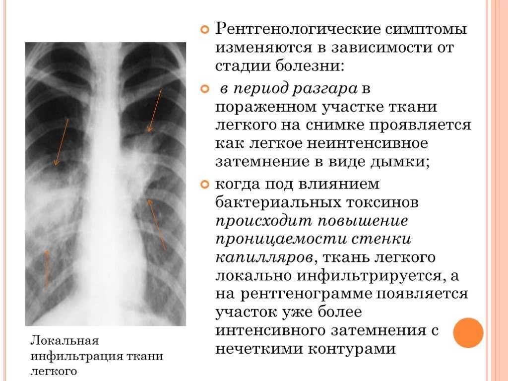 Очаговый туберкулез легких и туберкулёма.