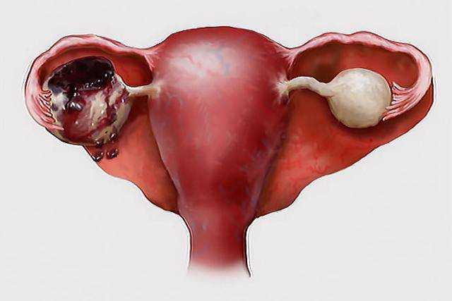 Ретенционная киста левого яичника: фото и успешное лечение | курортная клиника женского здоровья