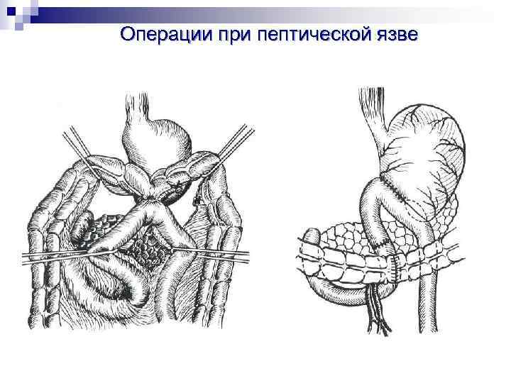 Анастомоз по ру схема