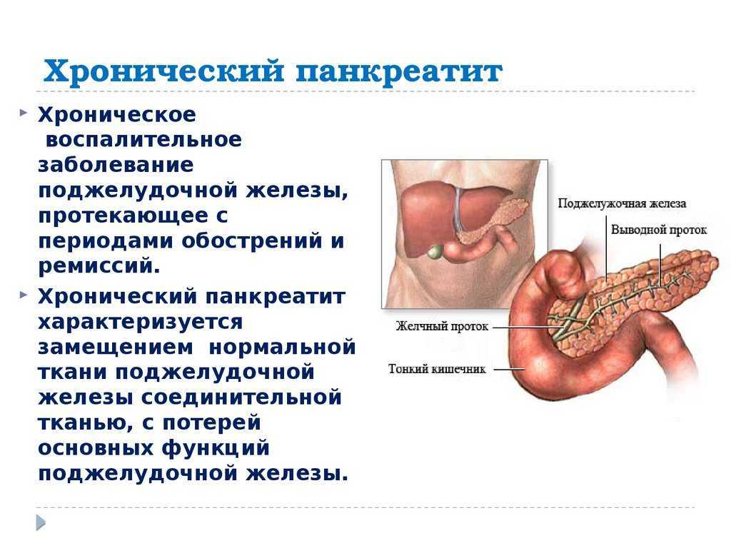 Панкреатит: симптомы, лечение, диагностика, диета | клиника «наедине»