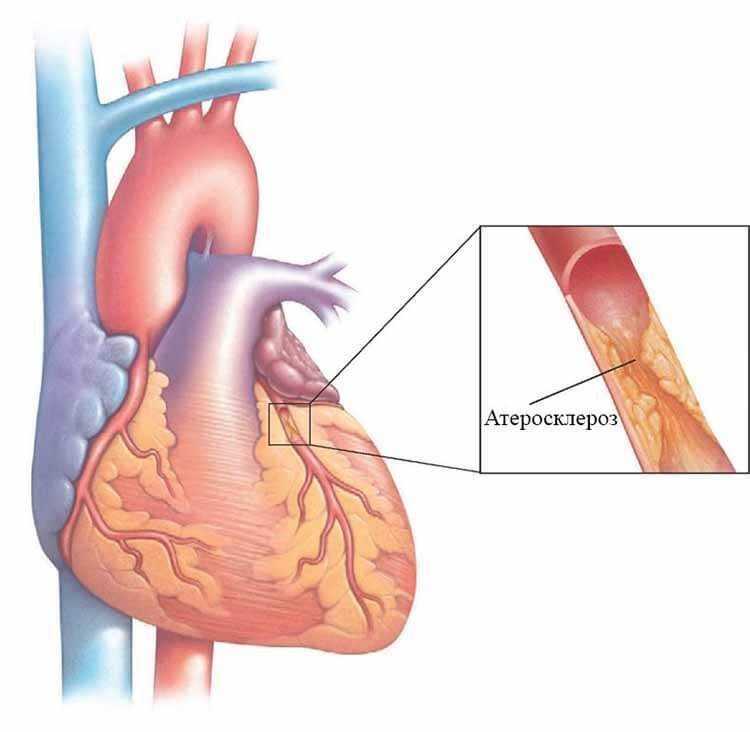 Сердечно сосудистые заболевания атеросклероз. Атеросклеротическая болезнь коронарных артерий. Симптомы атеросклероза коронарных артерий сердца. Атеросклероз аорты венечных артерий. Атеросклеротическое поражение коронарных сосудов.