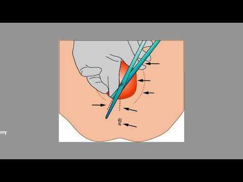 Перинеотомия и эпизиотомия презентация