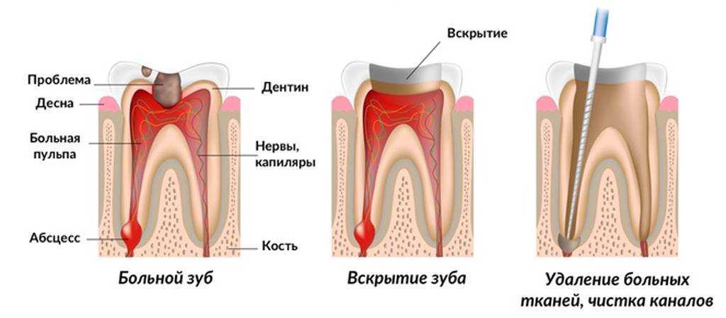 Что делать, если болит зуб после пломбирования – статьи стоматологической клиники «доктор мартин»
