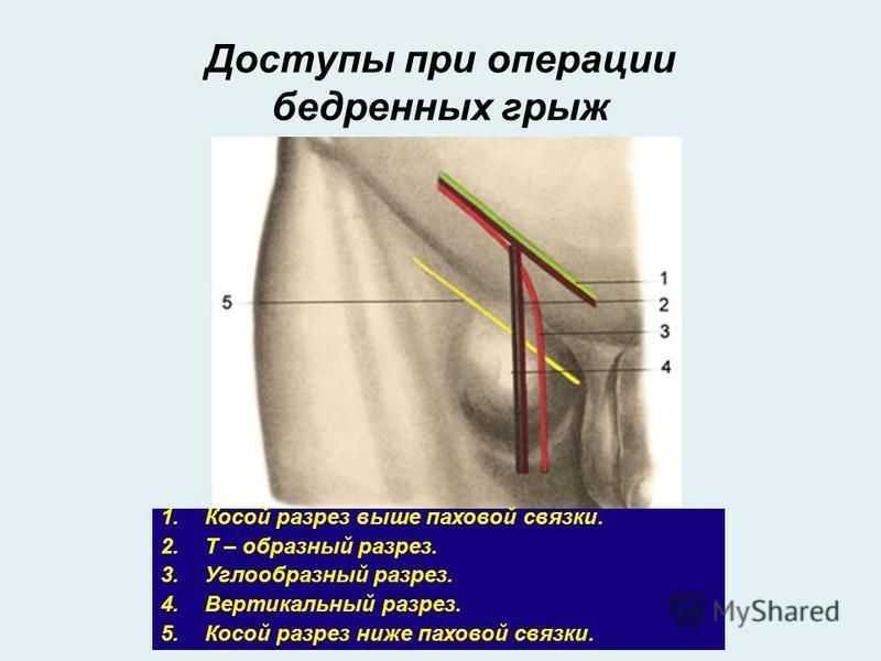 Паховая грыжа