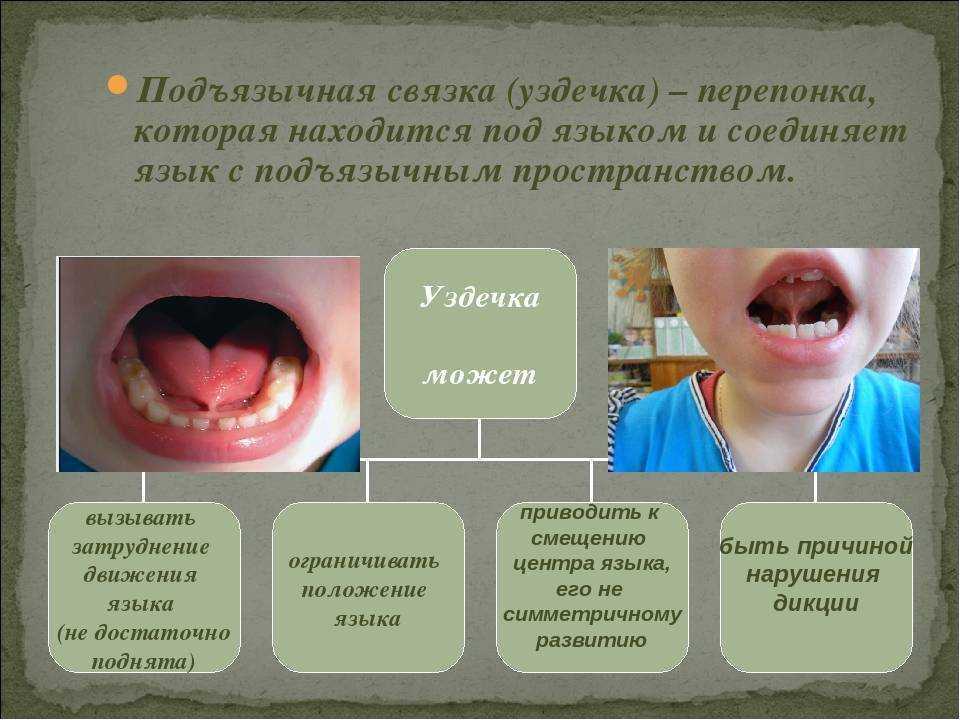 Классификация уздечек языка