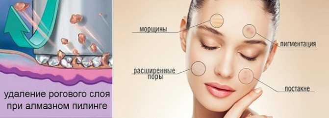 Алмазная микродермабразия лица - особенности и эффективность