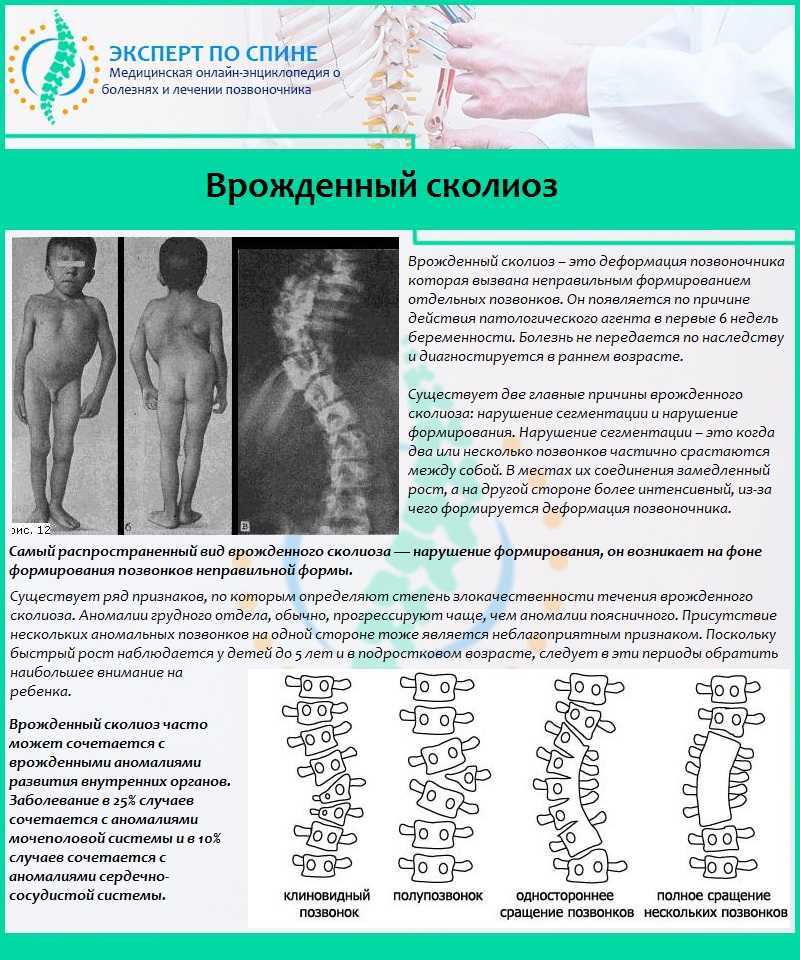 Лордоз поясничного отдела, симпьтомы, виды и его профилактика