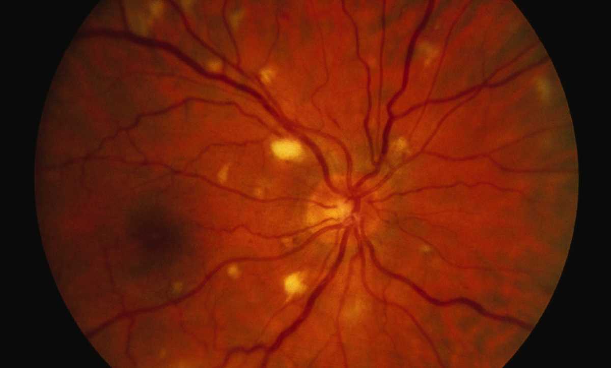 Клиника глаза сетчатки. Ретинопатия хориоретинит. Сифилитический ретинит. Сифилитический хориоретинит. Цитомегаловирусный хориоретинит.