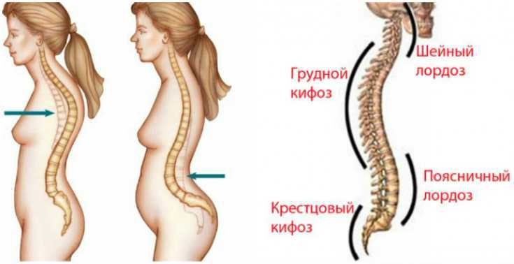 Кифотическая установка шейного отдела