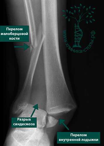 Перелом дистальной трети малоберцовой кости. Перелом малой берцовой кости. Голеностопный сустав перелом малоберцовой кости. Изолированный перелом малоберцовой кости. Малоберцовая лодыжка перелом.