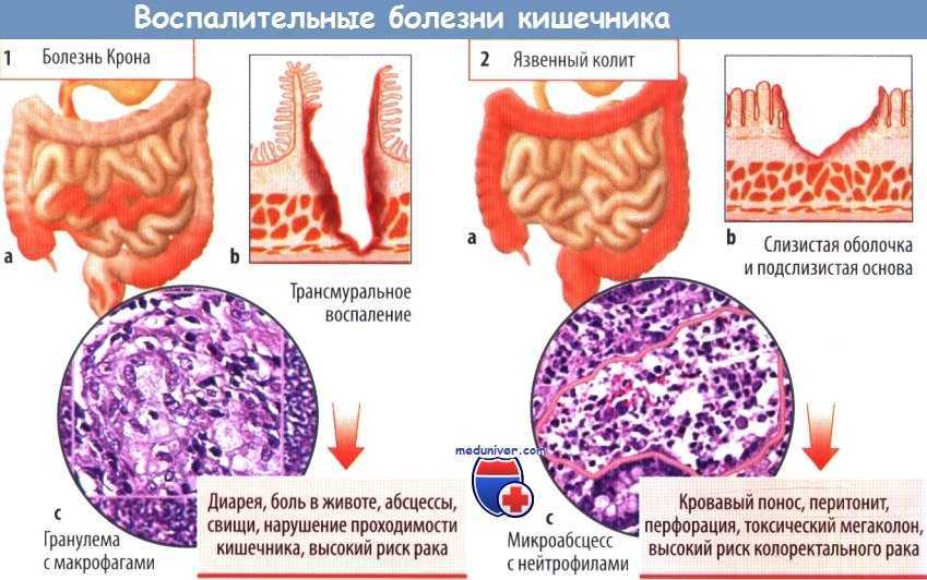 Диета при гастрите