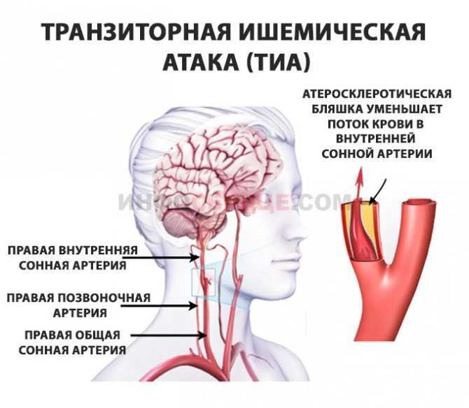 Ишемия мозга сколько живут. Ишемический инсульт поражения артерий. Транзиторный ишемический инсульт. Транзиторная ишемическая атака головного мозга. Тиа и ишемический инсульт.