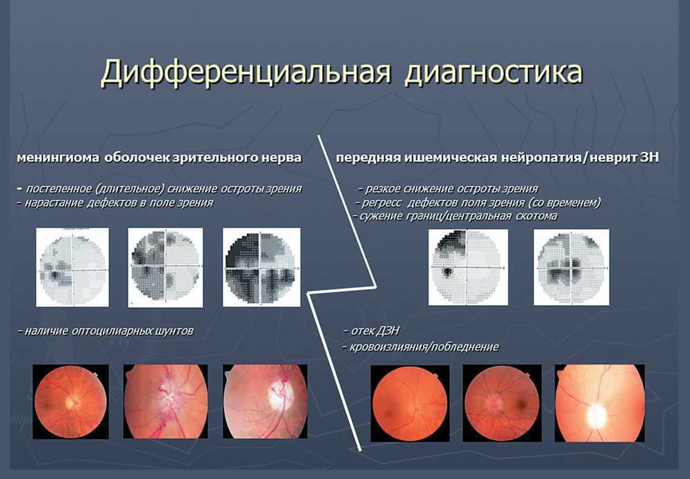 Нейропатия глаза. Застойный диск зрительного нерва дифференциальная диагностика. Дифференциальный диагноз отслойки сетчатки. Передняя ишемическая оптиконейропатия зрительный нерв. Менингиома зрительного нерва периметрия.