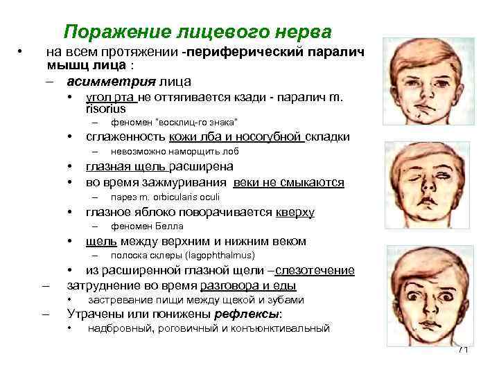 Невралгия тройничного нерва