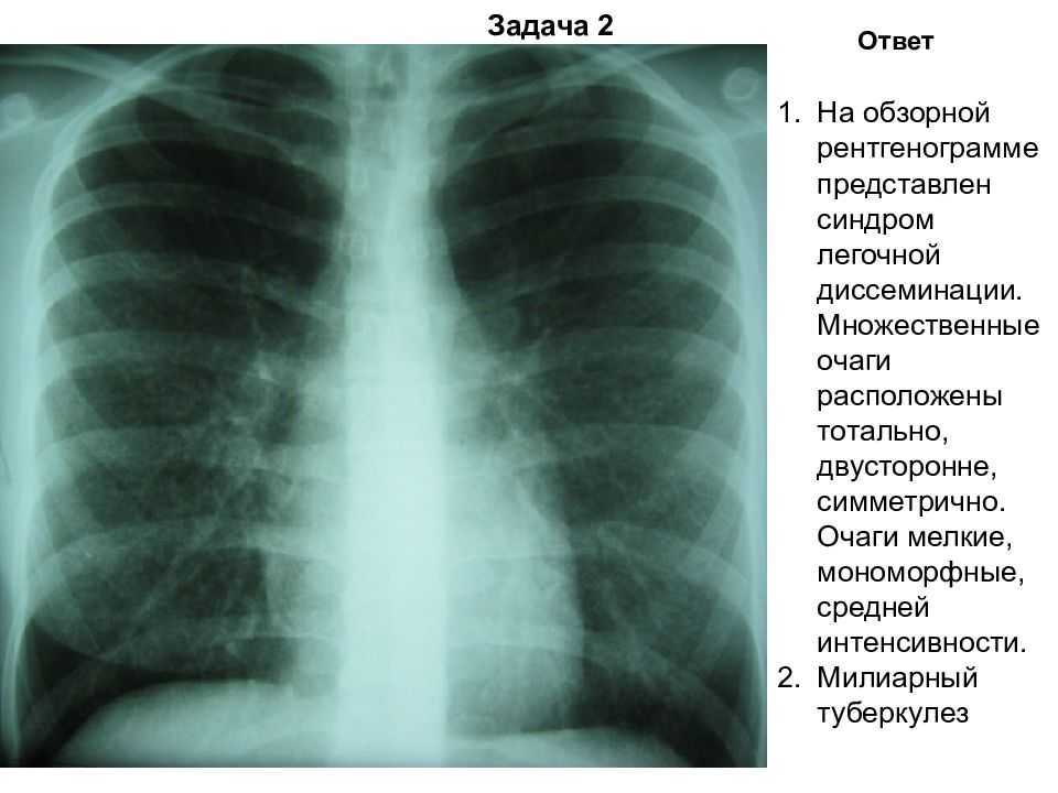 Хронический гематогенно-диссеминированный туберкулез легких